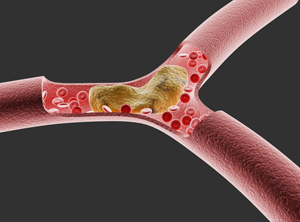Hypercholesterolemie in primaire preventie (Presentatie)