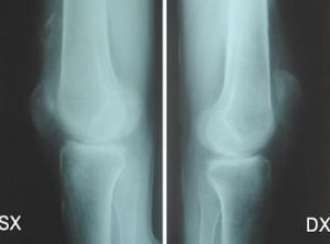Prise en charge de l'arthrose (Présentation)